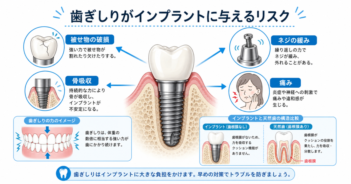 ■歯ぎしり・食いしばりがインプラントに与えるリスクとは