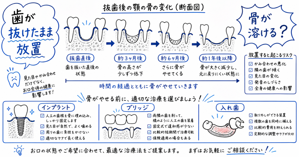 歯が抜けたまま放置で骨が溶ける?2年放置のリスクと3つの治療法