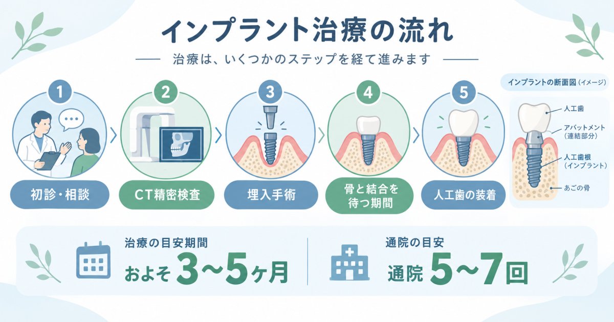 人工歯根の治療期間は何ヶ月？忙しい方の通院スケジュールを解説